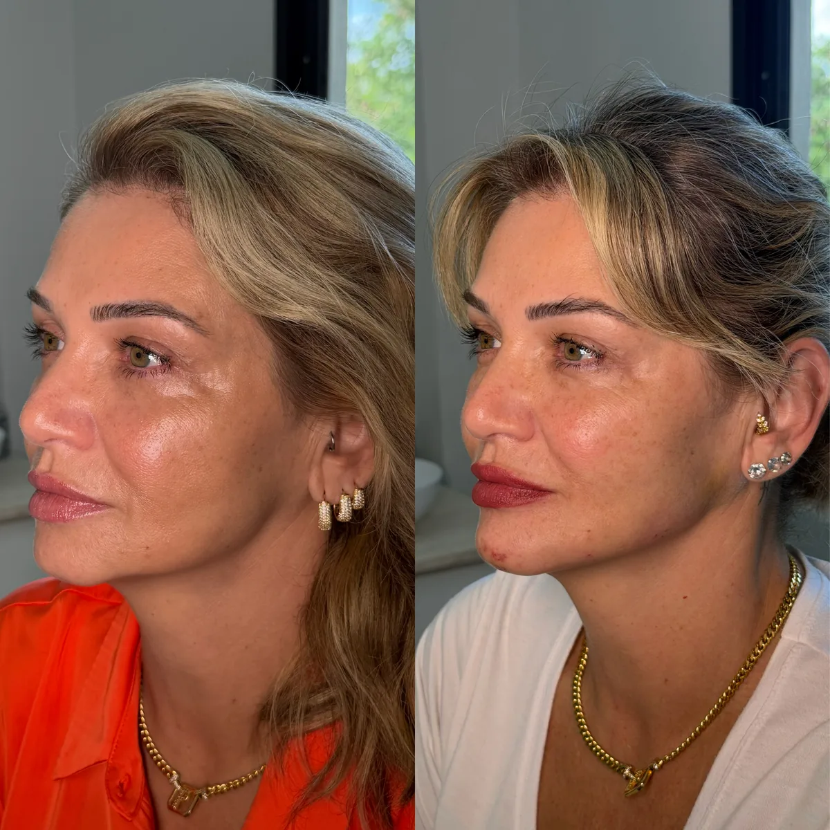 Contorno facial antes e depois do tratamento